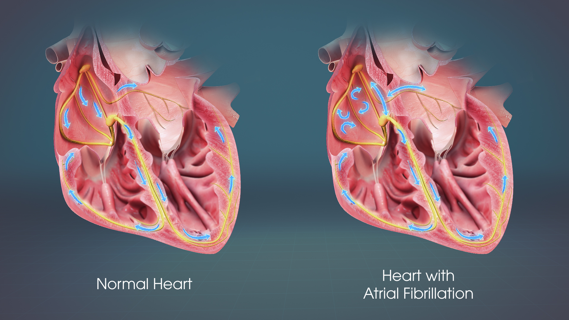 Capa: Avanço no tratamento da fibrilação atrial é incluído no Rol da ANS